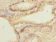 Immunohistochemistry of paraffin-embedded human prostate cancer using CSB-PA010000ESR1HU at dilution of 1:100