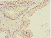 Immunohistochemistry of paraffin-embedded human prostate cancer using CSB-PA010000ESR2HU at dilution of 1:100