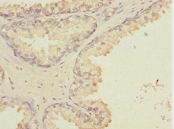 Immunohistochemistry of paraffin-embedded human prostate cancer using CSB-PA010000ESR2HU at dilution of 1:100