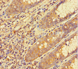 Immunohistochemistry of paraffin-embedded human colon cancer using CSB-PA010004HA01HU at dilution of 1:100