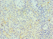 Immunohistochemistry of paraffin-embedded human breast cancer using CSB-PA010081ESR2HU at dilution of 1:100