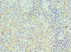 Immunohistochemistry of paraffin-embedded human breast cancer using CSB-PA010081ESR2HU at dilution of 1:100