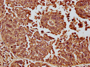 IHC image of CSB-PA010087OA11nme1HU diluted at 1:10 and staining in paraffin-embedded human cervical cancer performed on a Leica BondTM system. After dewaxing and hydration, antigen retrieval was mediated by high pressure in a citrate buffer (pH 6...