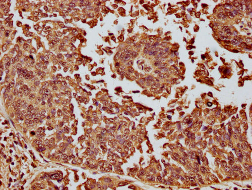 IHC image of CSB-PA010087OA11nme1HU diluted at 1:10 and staining in paraffin-embedded human cervical cancer performed on a Leica BondTM system. After dewaxing and hydration, antigen retrieval was mediated by high pressure in a citrate buffer (pH 6...