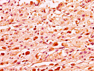 IHC image of CSB-PA010087OA81nme1HU diluted at 1:50 and staining in paraffin-embedded human melanoma performed on a Leica BondTM system. After dewaxing and hydration, antigen retrieval was mediated by high pressure in a citrate buffer (pH 6.0). Se...