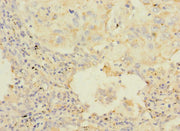 Immunohistochemistry of paraffin-embedded human lung cancer using CSB-PA010125ESR2HU at dilution of 1:100