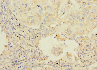 Immunohistochemistry of paraffin-embedded human lung cancer using CSB-PA010125ESR2HU at dilution of 1:100