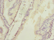 Immunohistochemistry of paraffin-embedded human prostate cancer using CSB-PA010126ESR2HU at dilution of 1:100