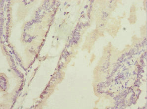 Immunohistochemistry of paraffin-embedded human prostate cancer using CSB-PA010126ESR2HU at dilution of 1:100