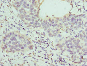 Immunohistochemistry of paraffin-embedded human bladder cancer using CSB-PA010130ESR2HU at dilution of 1:100