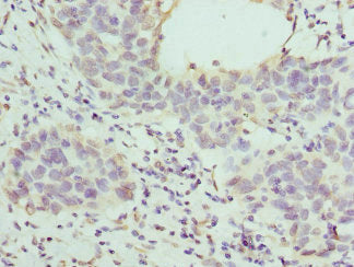 Immunohistochemistry of paraffin-embedded human bladder cancer using CSB-PA010130ESR2HU at dilution of 1:100