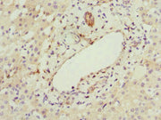 Immunohistochemistry of paraffin-embedded human liver cancer using CSB-PA010161ESR1HU at dilution of 1:100