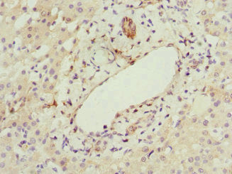 Immunohistochemistry of paraffin-embedded human liver cancer using CSB-PA010161ESR1HU at dilution of 1:100