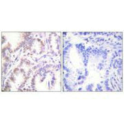 Immunohistochemistry analysis of paraffin-embedded human lung carcinoma tissue using CDK7 antibody.