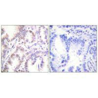 Immunohistochemistry analysis of paraffin-embedded human lung carcinoma tissue using CDK7 antibody.