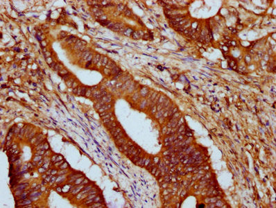 IHC image of CSB-PA010216LA01HU diluted at 1:500 and staining in paraffin-embedded human colon cancer performed on a Leica BondTM system. After dewaxing and hydration, antigen retrieval was mediated by high pressure in a citrate buffer (pH 6.0). S...