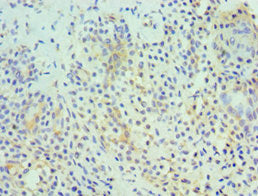 Immunohistochemistry of paraffin-embedded human breast cancer using CSB-PA010242ESR1HU at dilution of 1:100