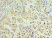 Immunohistochemistry of paraffin-embedded human lung cancer using CSB-PA010286ESR1HU at dilution of 1:100