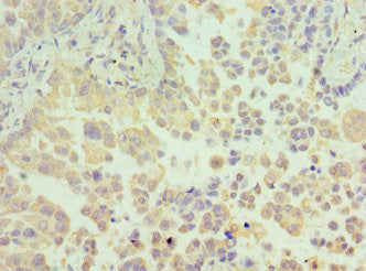 Immunohistochemistry of paraffin-embedded human lung cancer using CSB-PA010286ESR1HU at dilution of 1:100