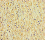 Immunohistochemistry of paraffin-embedded human liver cancer using CSB-PA010288LA01HU at dilution of 1:100