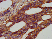 IHC image of CSB-PA010316LA01HU diluted at 1:300 and staining in paraffin-embedded human colon cancer performed on a Leica BondTM system. After dewaxing and hydration, antigen retrieval was mediated by high pressure in a citrate buffer (pH 6.0). S...