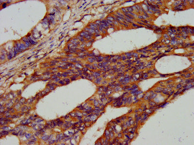 IHC image of CSB-PA010316LA01HU diluted at 1:300 and staining in paraffin-embedded human colon cancer performed on a Leica BondTM system. After dewaxing and hydration, antigen retrieval was mediated by high pressure in a citrate buffer (pH 6.0). S...