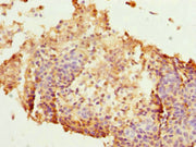 Immunohistochemistry of paraffin-embedded human cervical cancer using CSB-PA010318DSR1HU at dilution of 1:100