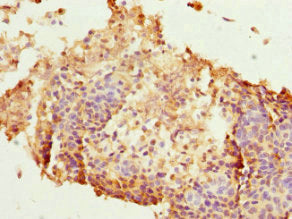 Immunohistochemistry of paraffin-embedded human cervical cancer using CSB-PA010318DSR1HU at dilution of 1:100