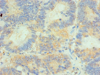 Immunohistochemistry of paraffin-embedded human colon cancer using CSB-PA010365ESR1HU at dilution of 1:100