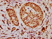 IHC image of CSB-PA010376OA21nacHU diluted at 1:15 and staining in paraffin-embedded human pancreatic cancer performed on a Leica BondTM system. After dewaxing and hydration, antigen retrieval was mediated by high pressure in a citrate buffer (pH...