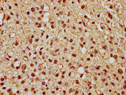 IHC image of CSB-PA010376OA21nme1HU diluted at 1:10 and staining in paraffin-embedded human glioma cancer performed on a Leica BondTM system. After dewaxing and hydration, antigen retrieval was mediated by high pressure in a citrate buffer (pH 6.0...