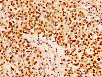 Immunohistochemistry of paraffin-embedded human colon cancer using CSB-PA010377PA10nphHU at dilution of 1:100