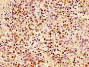 Immunohistochemistry of paraffin-embedded human colon cancer using CSB-PA010377PA17nphHU at dilution of 1:100