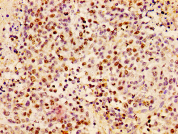 Immunohistochemistry of paraffin-embedded human colon cancer using CSB-PA010377PA17nphHU at dilution of 1:100