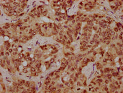 IHC image of CSB-PA010378OA116nhibHU diluted at 1:10 and staining in paraffin-embedded human liver cancer performed on a Leica BondTM system. After dewaxing and hydration, antigen retrieval was mediated by high pressure in a citrate buffer (pH 6.0...