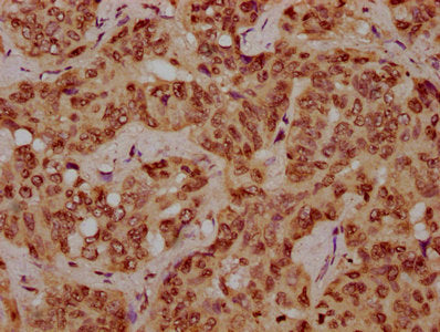 IHC image of CSB-PA010378OA116nhibHU diluted at 1:10 and staining in paraffin-embedded human liver cancer performed on a Leica BondTM system. After dewaxing and hydration, antigen retrieval was mediated by high pressure in a citrate buffer (pH 6.0...
