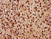 IHC image of CSB-PA010378OA168nhibHU diluted at 1:10 and staining in paraffin-embedded human glioma performed on a Leica BondTM system. After dewaxing and hydration, antigen retrieval was mediated by high pressure in a citrate buffer (pH 6.0). Sec...