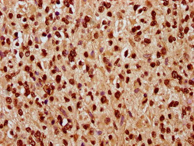 IHC image of CSB-PA010378OA168nhibHU diluted at 1:10 and staining in paraffin-embedded human glioma performed on a Leica BondTM system. After dewaxing and hydration, antigen retrieval was mediated by high pressure in a citrate buffer (pH 6.0). Sec...