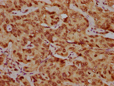 IHC image of CSB-PA010378OA210nhibHU diluted at 1:20 and staining in paraffin-embedded human liver cancer performed on a Leica BondTM system. After dewaxing and hydration, antigen retrieval was mediated by high pressure in a citrate buffer (pH 6.0...