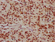 IHC image of CSB-PA010378OA26nhibHU diluted at 1:20 and staining in paraffin-embedded human glioma performed on a Leica BondTM system. After dewaxing and hydration, antigen retrieval was mediated by high pressure in a citrate buffer (pH 6.0). Sect...