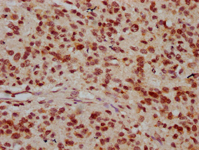 IHC image of CSB-PA010378OA26nhibHU diluted at 1:20 and staining in paraffin-embedded human glioma performed on a Leica BondTM system. After dewaxing and hydration, antigen retrieval was mediated by high pressure in a citrate buffer (pH 6.0). Sect...