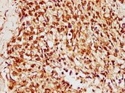 IHC image of CSB-PA010378OA33ncrHU diluted at 1:10 and staining in paraffin-embedded human ovarian cancer performed on a Leica BondTM system. After dewaxing and hydration, antigen retrieval was mediated by high pressure in a citrate buffer (pH 6.0...