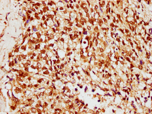 IHC image of CSB-PA010378OA33ncrHU diluted at 1:10 and staining in paraffin-embedded human ovarian cancer performed on a Leica BondTM system. After dewaxing and hydration, antigen retrieval was mediated by high pressure in a citrate buffer (pH 6.0...