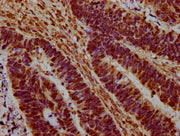 IHC image of CSB-PA010378OA45nme1HU diluted at 1:20 and staining in paraffin-embedded human ovarian cancer performed on a Leica BondTM system. After dewaxing and hydration, antigen retrieval was mediated by high pressure in a citrate buffer (pH 6....