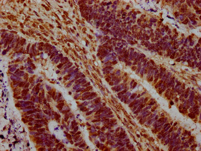 IHC image of CSB-PA010378OA45nme1HU diluted at 1:20 and staining in paraffin-embedded human ovarian cancer performed on a Leica BondTM system. After dewaxing and hydration, antigen retrieval was mediated by high pressure in a citrate buffer (pH 6....