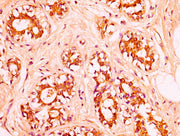 IHC image of CSB-PA010378OA62nsucHU diluted at 1:50 and staining in paraffin-embedded human breast cancer performed on a Leica BondTM system. After dewaxing and hydration, antigen retrieval was mediated by high pressure in a citrate buffer (pH 6.0...