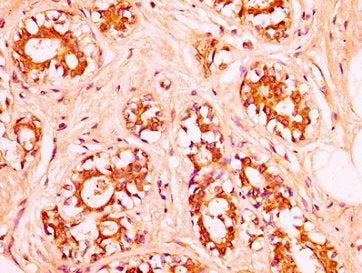 IHC image of CSB-PA010378OA62nsucHU diluted at 1:50 and staining in paraffin-embedded human breast cancer performed on a Leica BondTM system. After dewaxing and hydration, antigen retrieval was mediated by high pressure in a citrate buffer (pH 6.0...