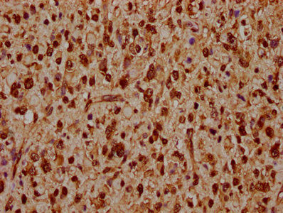 IHC image of CSB-PA010378OA74nhibHU diluted at 1:20 and staining in paraffin-embedded human glioma performed on a Leica BondTM system. After dewaxing and hydration, antigen retrieval was mediated by high pressure in a citrate buffer (pH 6.0). Sect...
