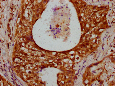 IHC image of CSB-PA010378OA80nhibHU diluted at 1:10 and staining in paraffin-embedded human cervical cancer performed on a Leica BondTM system. After dewaxing and hydration, antigen retrieval was mediated by high pressure in a citrate buffer (pH 6...
