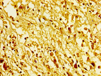 IHC image of CSB-PA010378OA96ncrHU diluted at 1:5 and staining in paraffin-embedded human melanoma performed on a Leica BondTM system. After dewaxing and hydration, antigen retrieval was mediated by high pressure in a citrate buffer (pH 6.0). Sect...